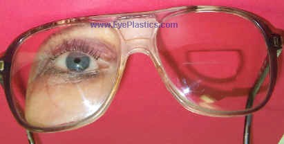 Exposed orbital implant requiring surgical repair