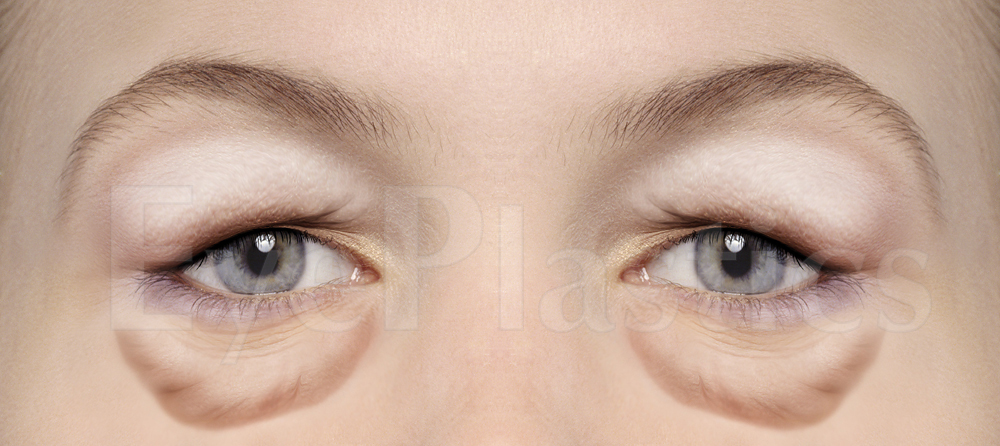 Four-lid blepharoplasty before and after