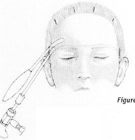Endoscopic brow lift — step 5