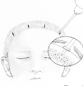 Endoscopic brow lift — step 7