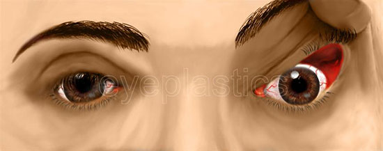Floppy eyelid syndrome — easily everted upper eyelid