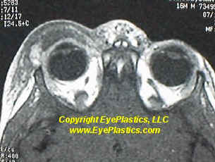 Periorbital eyelid inflammation