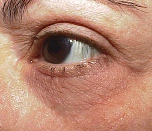 Laser resurfacing โ pre-operative assessment