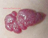 Infantile hemangioma during propranolol treatment