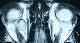 Cavernous hemangioma of the orbit — CT imaging