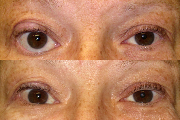 Thyroid eye disease — axial CT showing muscle enlargement